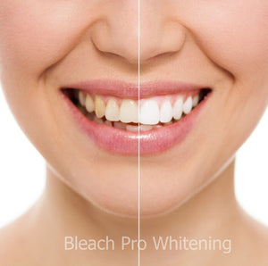 Teeth Whitening Gel Tooth Bleaching Syringe Dispensers 35% Carbamide Peroxide Dental Whitener 40ml 4 Pcs